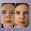 Before and after results of azelaic acid, showing reduced pigmentation and brighter skin