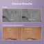 Azelaic acid before and after results showing reduced pigmentation on cheek and forehead