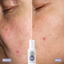 Azelaic before and after 