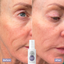 Azelaic before and after 