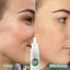 Niacinamide before and after results. 